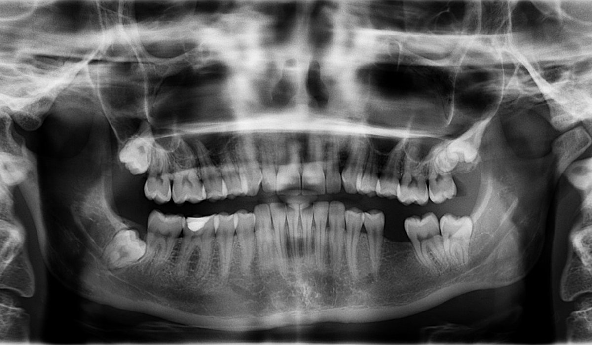 How to Budget for Replacing Several Missing Teeth